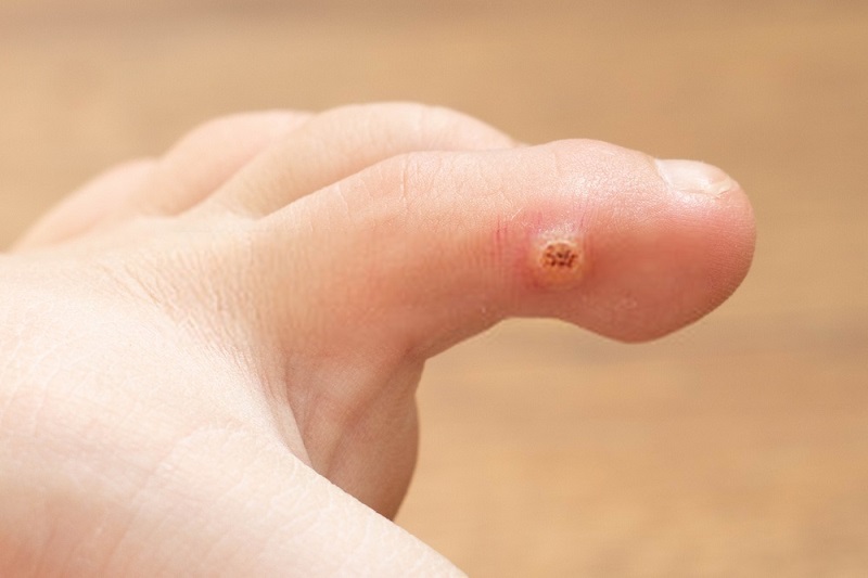 Beauty-Benefits-Of-Coconut-Oil-Coconut-oil-against-warts