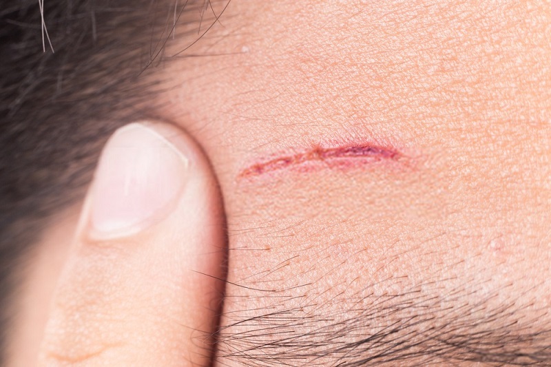 Beauty-Benefits-Of-Coconut-Oil-Coconut-oil-on-scars