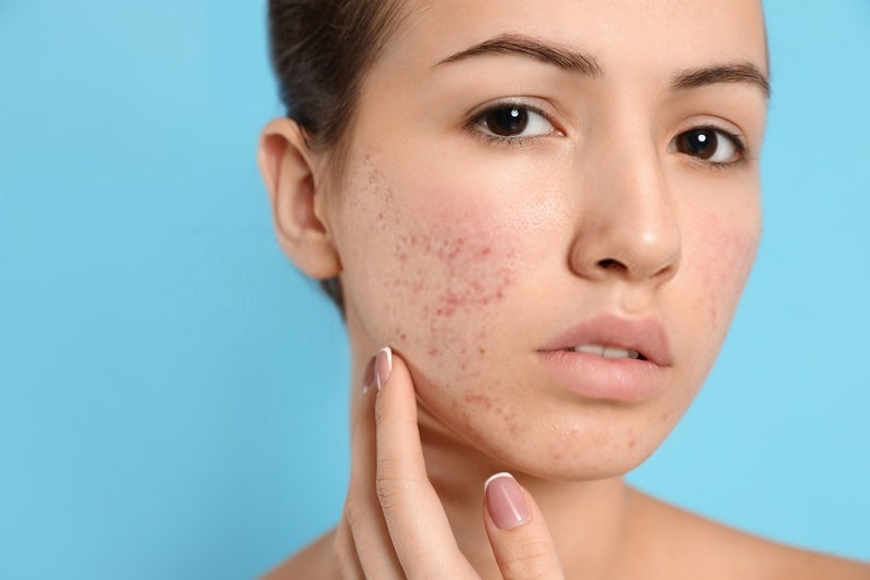 Beauty-Benefits-Of-Coconut-Oil-Coconut-oil-against-boils-and-acne
