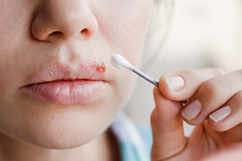 Beauty-Benefits-Of-Coconut-Oil-Coconut-oil-against-herpes