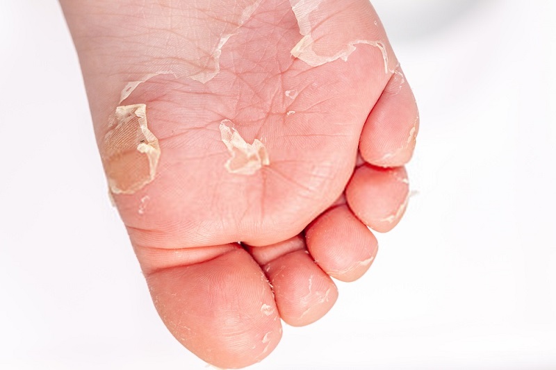 Beauty-Benefits-Of-Coconut-Oil-Foot-peeling-with-coconut-oil